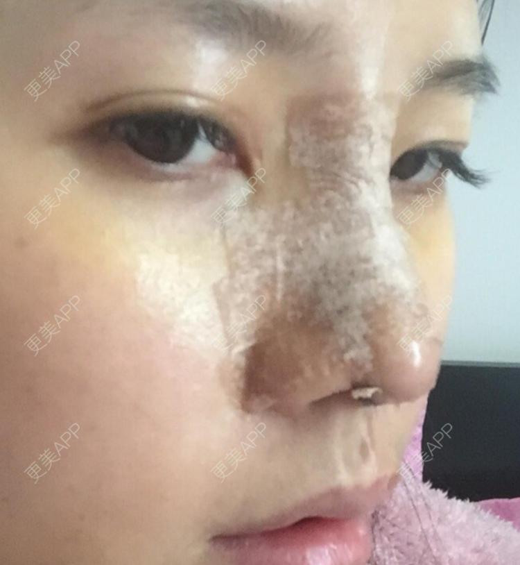 更美 - 更美用户DNEBeajwSz的埋线隆鼻经验 | 埋线隆鼻