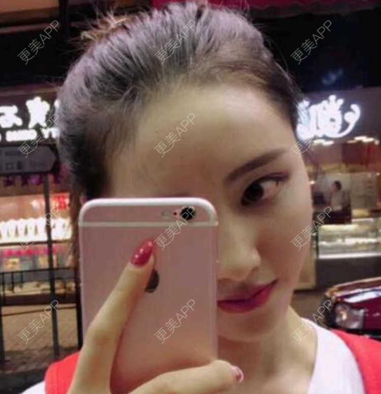 更美 - 更美用户DNEBeajwSz的埋线隆鼻经验 | 埋线隆鼻