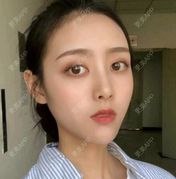 更美 - 更美用户DNEBeajwSz的埋线隆鼻经验 | 埋线隆鼻