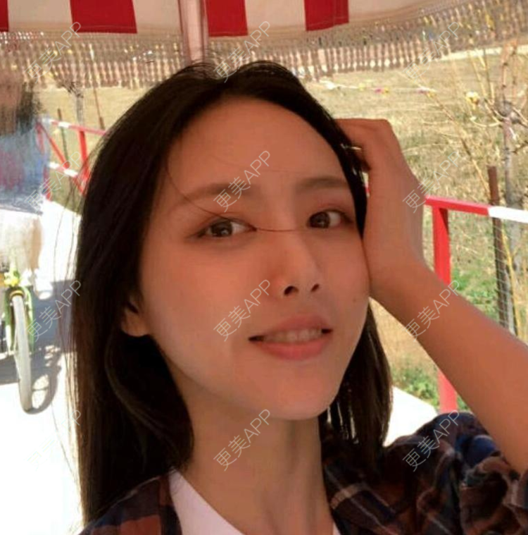 更美 - 更美用户DNEBeajwSz的埋线隆鼻经验 | 埋线隆鼻