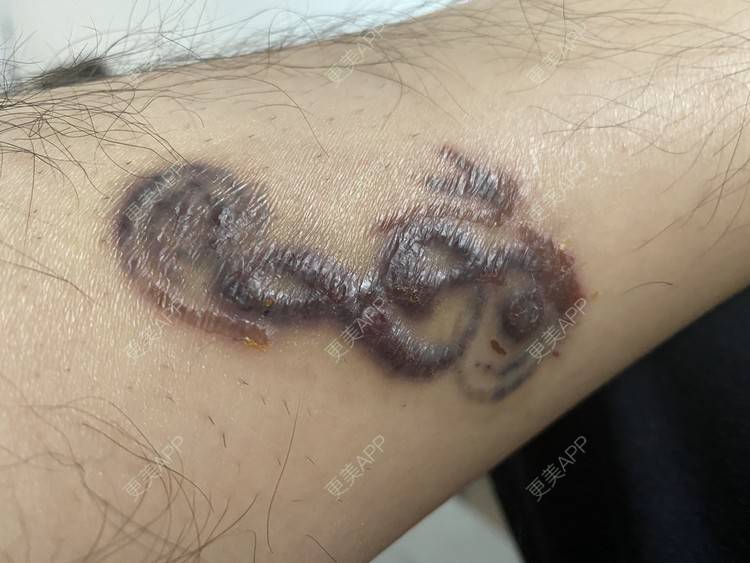 更美用户mpwyz2ch2v的激光洗纹身日记