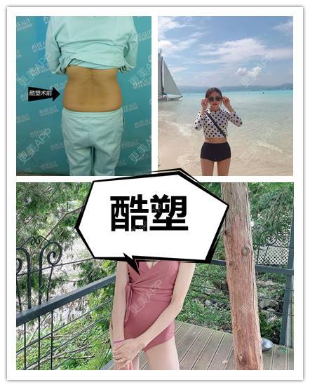 更美 - 更美用户oAH4toi7Az的冷冻减脂瘦腹部经验 | 冷冻减脂瘦腹部 | 重庆