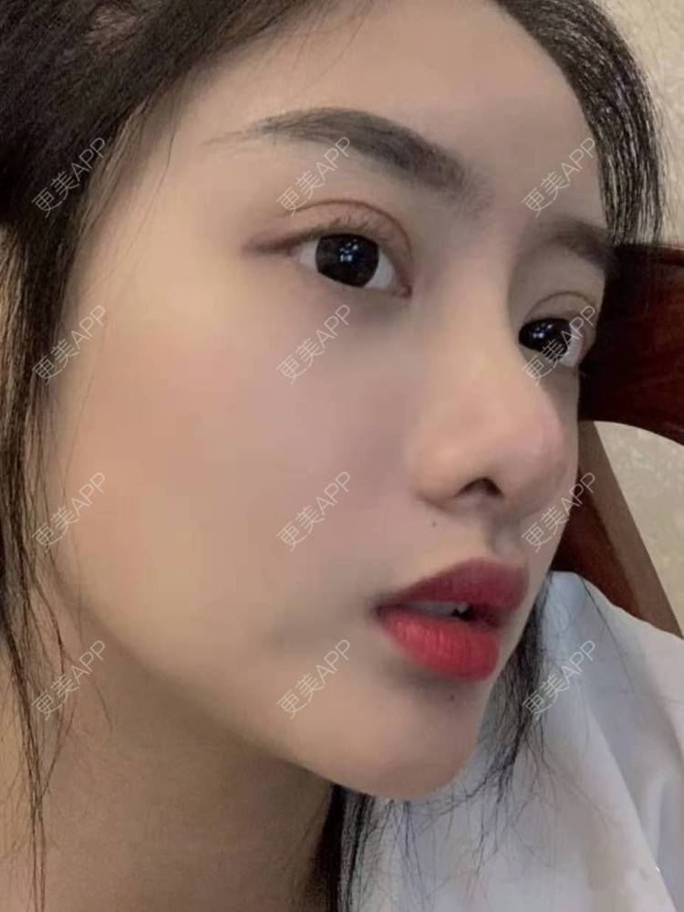 双眼皮,双眼皮效果图__酱宝618双眼皮效果图_术后90天__更美