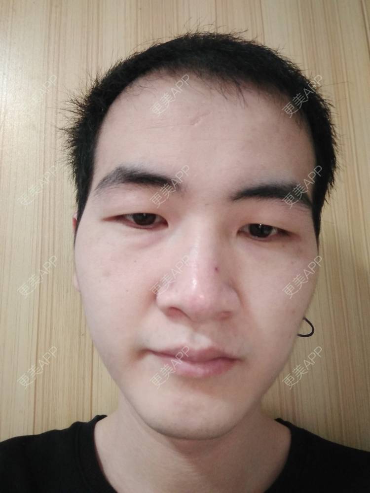 更美 - 更美用户wHSFRCieMm的植胡须经验 | 武汉 | 植胡须