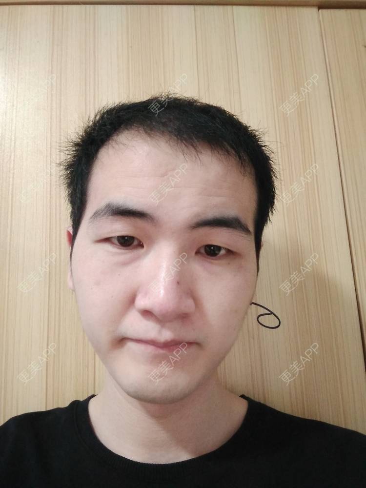 更美 - 更美用户wHSFRCieMm的植胡须经验 | 武汉 | 植胡须
