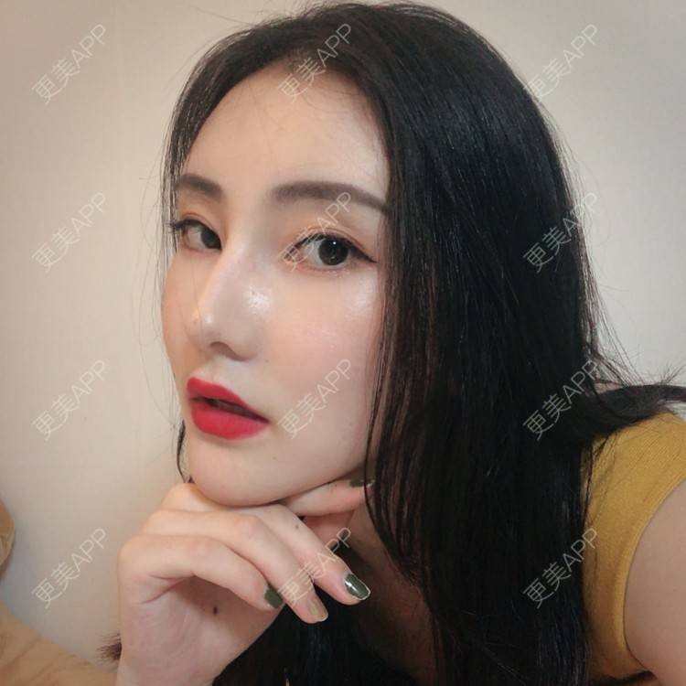 更美 - 你的奶酪掉了的埋线提升经验 | 埋线提升 | 视频日记 | 重庆
