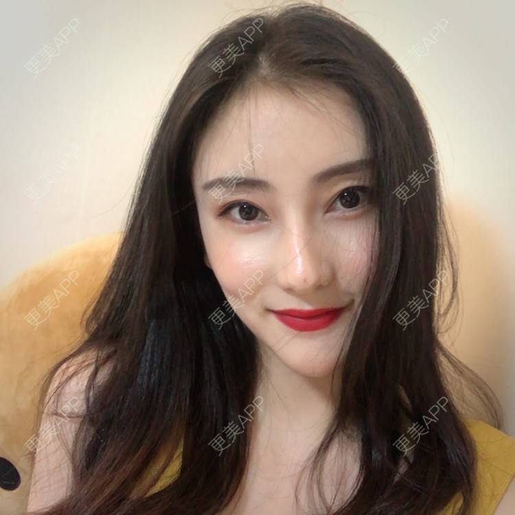 更美 - 你的奶酪掉了的埋线提升经验 | 埋线提升 | 视频日记 | 重庆