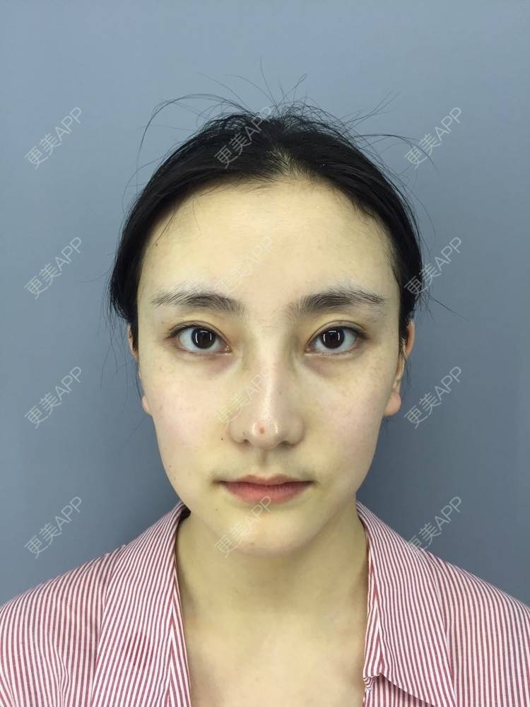 更美 - 你的奶酪掉了的埋线提升经验 | 埋线提升 | 视频日记 | 重庆