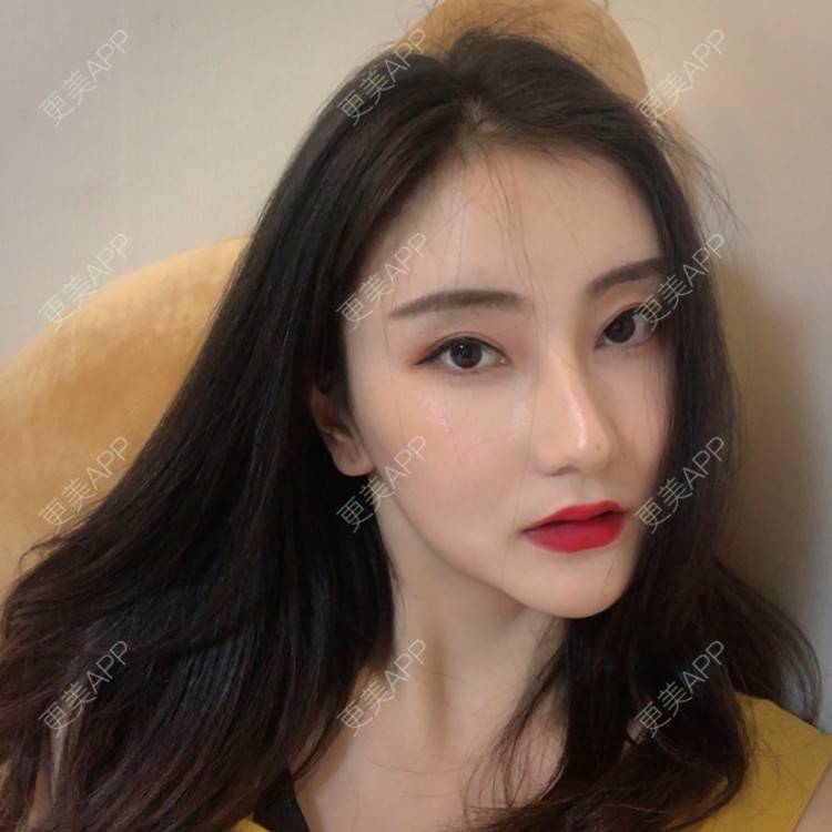 更美 - 你的奶酪掉了的埋线提升经验 | 埋线提升 | 视频日记 | 重庆
