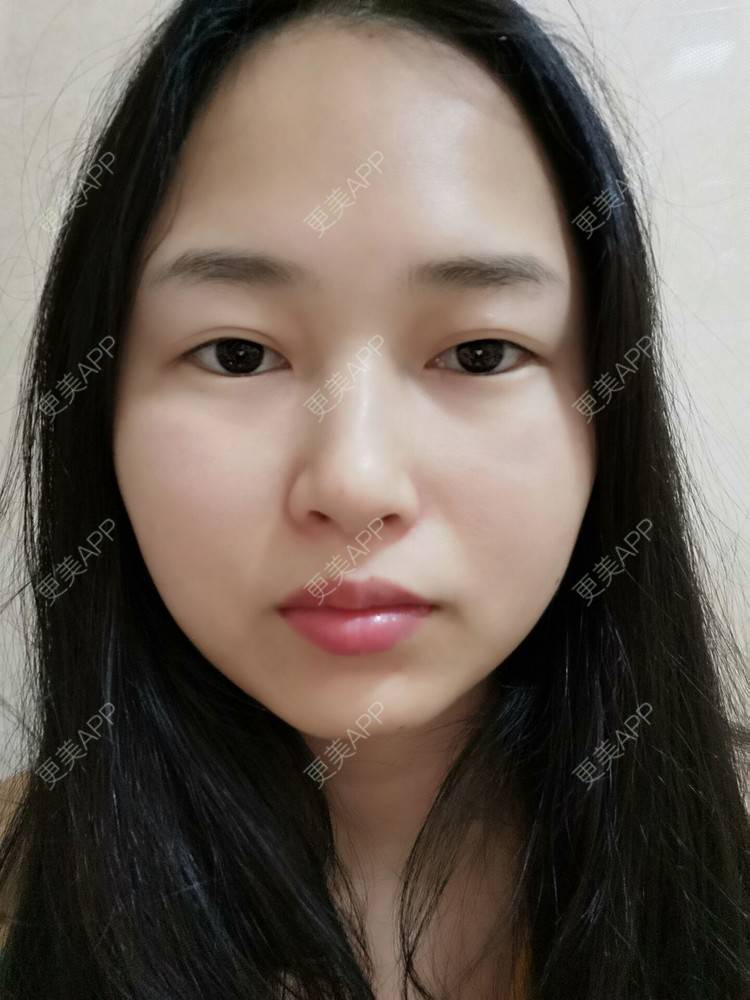 更美 - 小桃桃源的清洁水光补水经验 | 皮肤综合管理套餐 | 广州 | 清洁水光补水