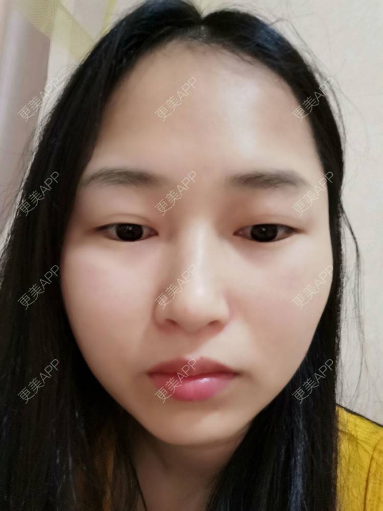 更美 - 小桃桃源的清洁水光补水经验 | 皮肤综合管理套餐 | 广州 | 清洁水光补水