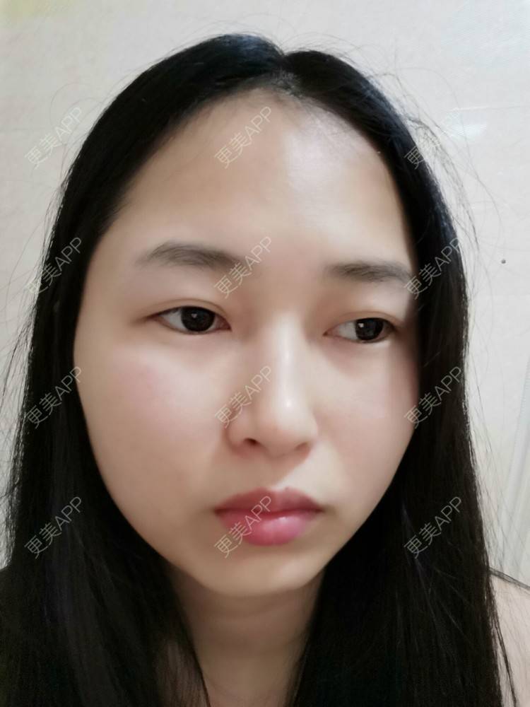 更美 - 小桃桃源的清洁水光补水经验 | 皮肤综合管理套餐 | 广州 | 清洁水光补水