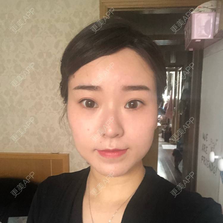 更美 - 田小雕的除皱瘦脸经验 | 除皱瘦脸 | 宁波