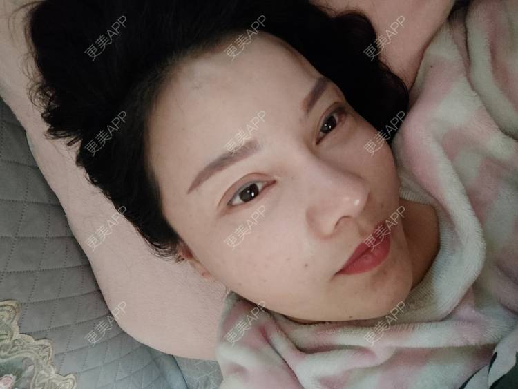 更美 - 更美用户xZI1wSP5Ch的隆鼻经验 | 隆鼻 | 肋软骨隆鼻 | 上海 | 自体肋软骨垫鼻基底