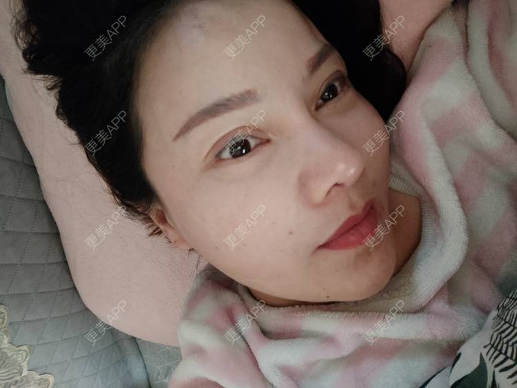 更美 - 更美用户xZI1wSP5Ch的隆鼻经验 | 隆鼻 | 肋软骨隆鼻 | 上海 | 自体肋软骨垫鼻基底