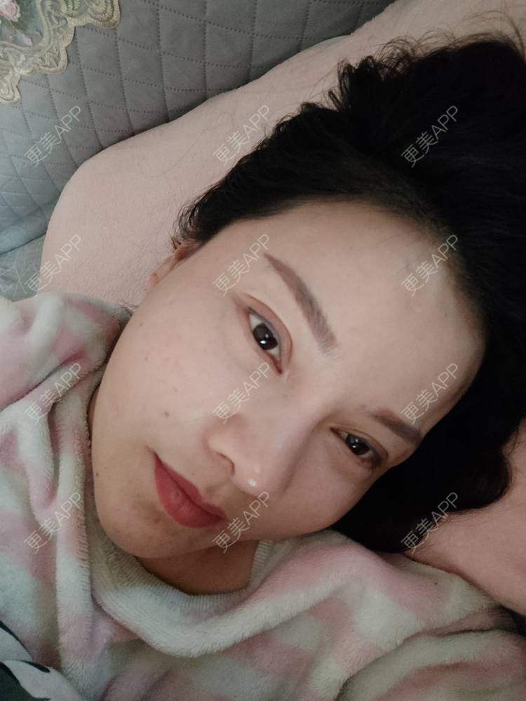 更美 - 更美用户xZI1wSP5Ch的隆鼻经验 | 隆鼻 | 肋软骨隆鼻 | 上海 | 自体肋软骨垫鼻基底