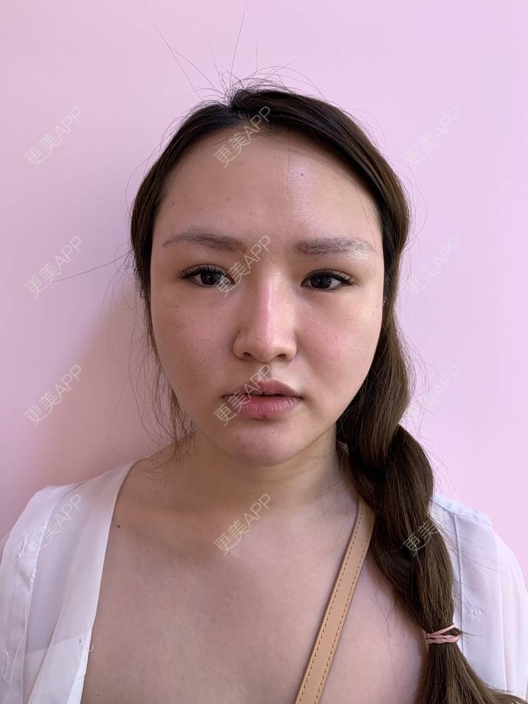更美 - 更美用户GmtEkZsW9u的瘦脸经验 | 瘦脸 | 双下巴吸脂
