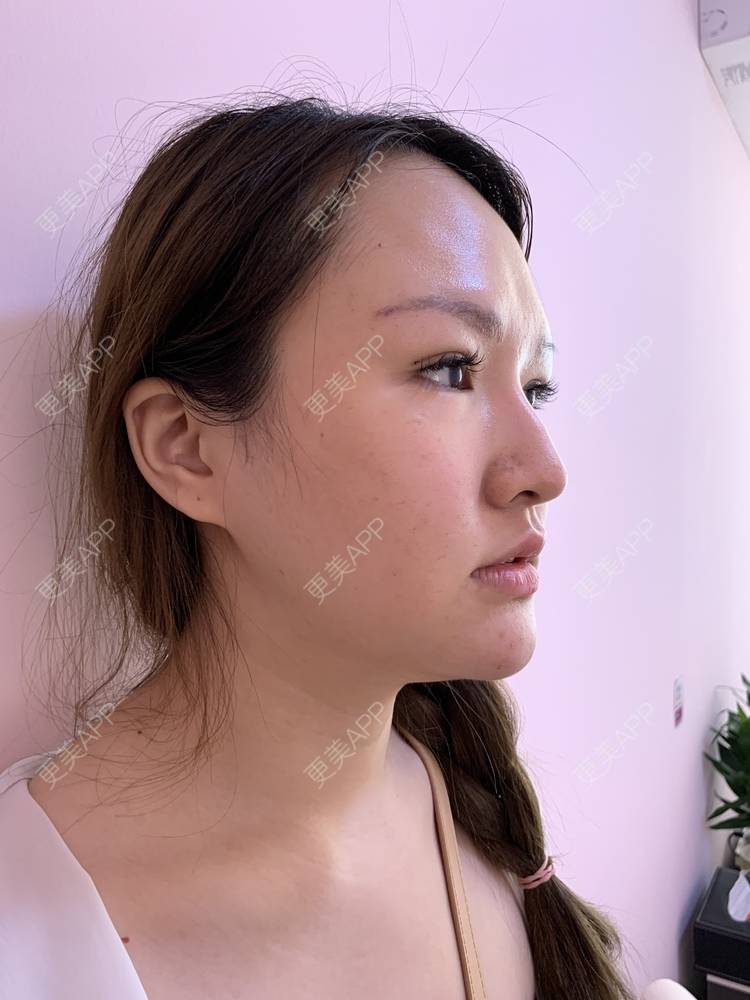 更美 - 更美用户GmtEkZsW9u的瘦脸经验 | 瘦脸 | 双下巴吸脂