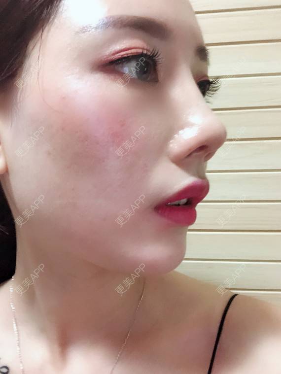 更美 - 更美用户VfI2TE1aYQ的鼻部多项经验 | 鼻部多项 | 重庆