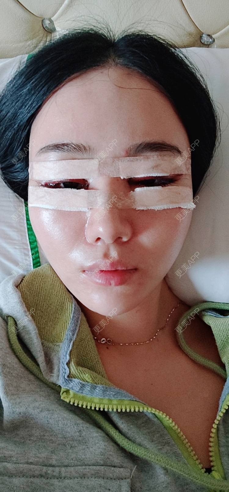 更美 - 欣欣的全切双眼皮经验 | 眼部多项 | 眼睑下至 | 开内眼角 | 开外眼角 | 全切双眼皮 | 东莞