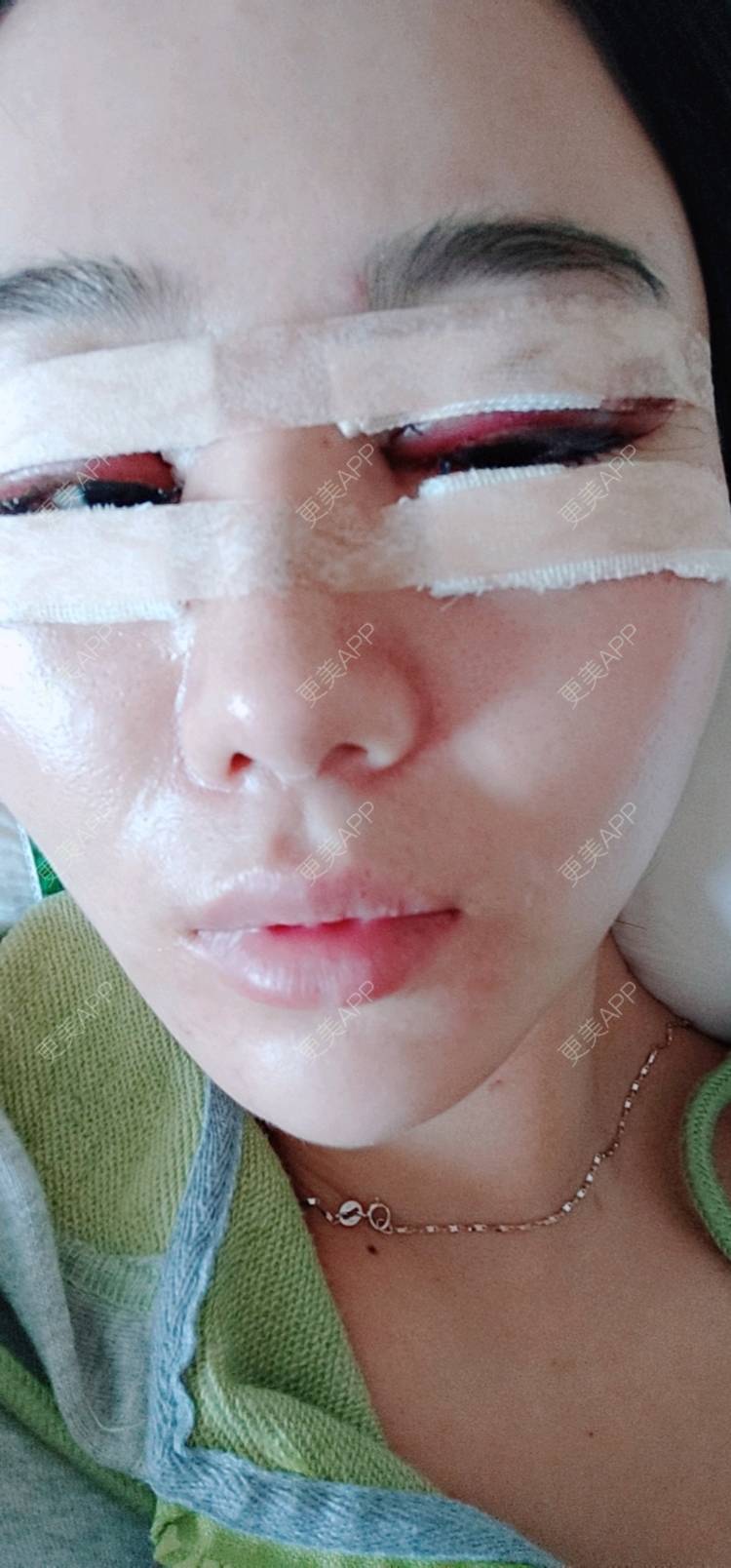 更美 - 欣欣的全切双眼皮经验 | 眼部多项 | 眼睑下至 | 开内眼角 | 开外眼角 | 全切双眼皮 | 东莞