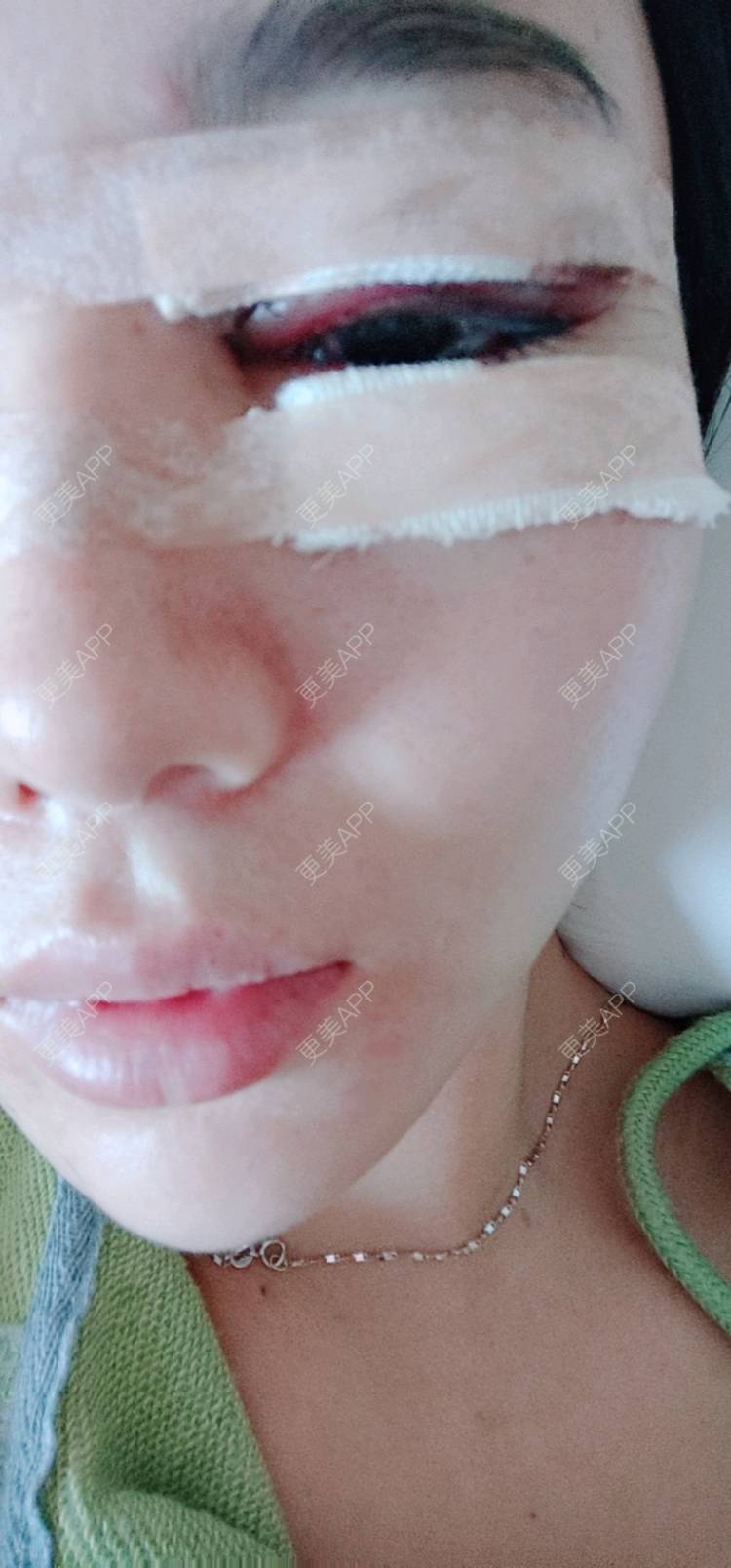 更美 - 欣欣的全切双眼皮经验 | 眼部多项 | 眼睑下至 | 开内眼角 | 开外眼角 | 全切双眼皮 | 东莞