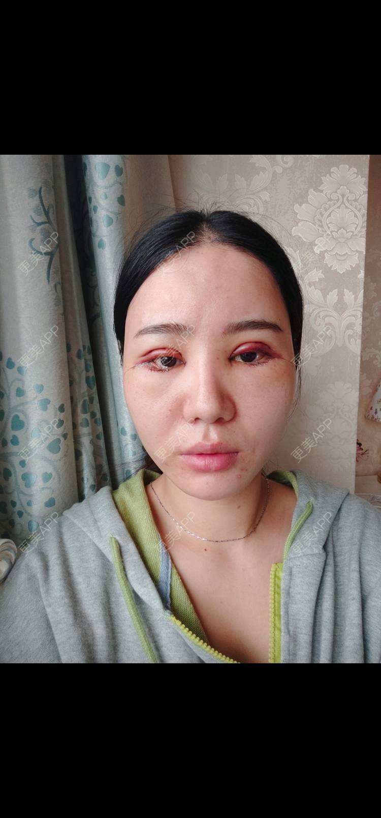 更美 - 欣欣的全切双眼皮经验 | 全切双眼皮 | 开内眼角 | 开外眼角 | 东莞 | 眼睑下至 | 眼部多项