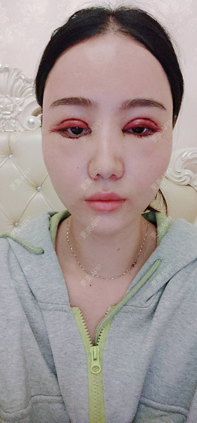 欣欣的全切双眼皮日记