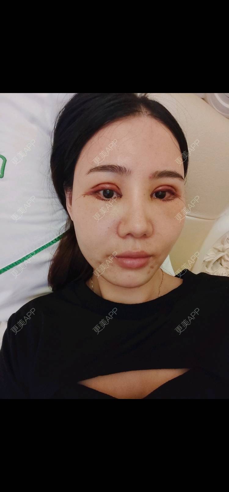 更美 - 欣欣的全切双眼皮经验 | 全切双眼皮 | 开内眼角 | 开外眼角 | 东莞 | 眼睑下至 | 眼部多项