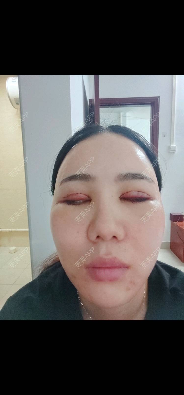 更美 - 欣欣的全切双眼皮经验 | 全切双眼皮 | 开内眼角 | 开外眼角 | 东莞 | 眼睑下至 | 眼部多项