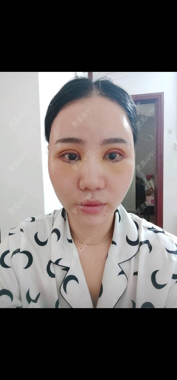 更美 - 欣欣的全切双眼皮经验 | 全切双眼皮 | 开内眼角 | 开外眼角 | 东莞 | 眼睑下至 | 眼部多项