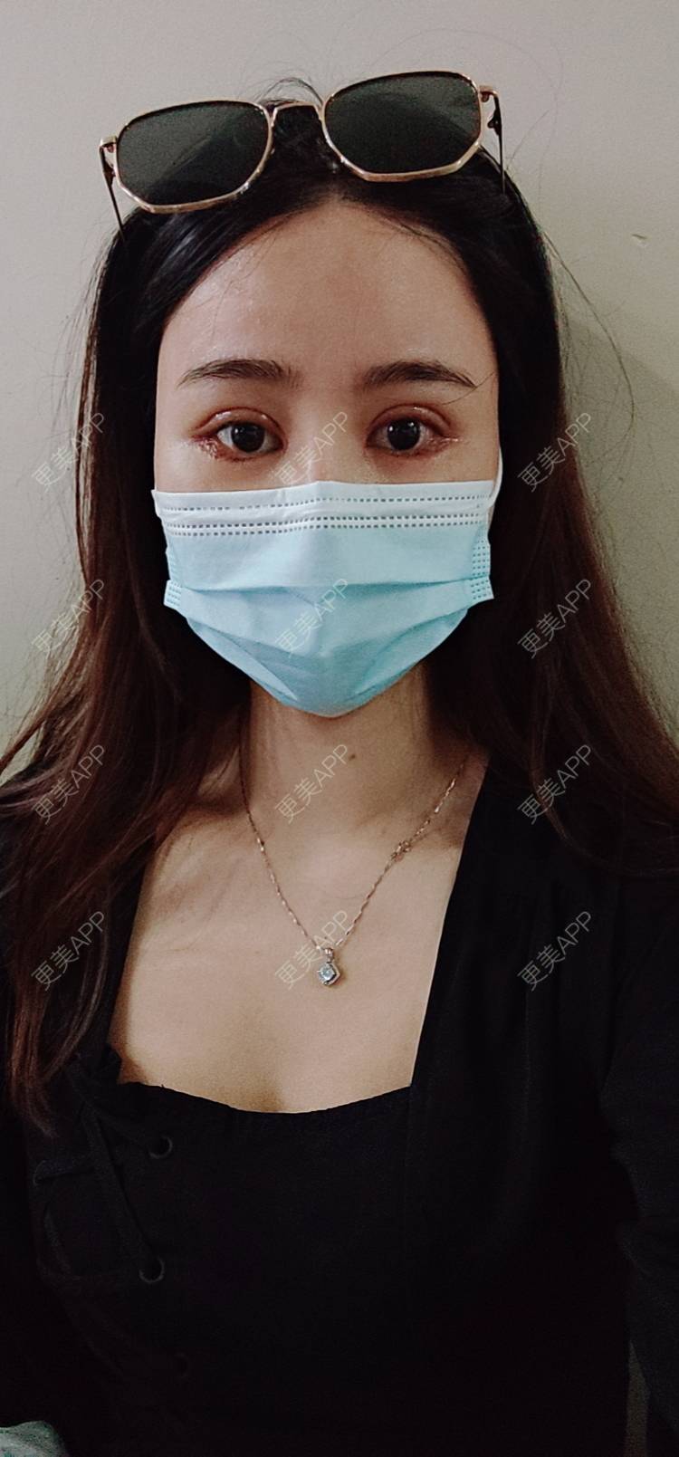 更美 - 欣欣的全切双眼皮经验 | 全切双眼皮 | 开内眼角 | 开外眼角 | 东莞 | 眼睑下至 | 眼部多项