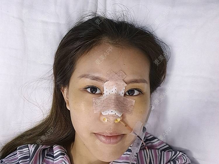 更美 - 很酷但不主动的隆鼻经验 | 硅胶隆鼻 | 肋软骨隆鼻 | 深圳