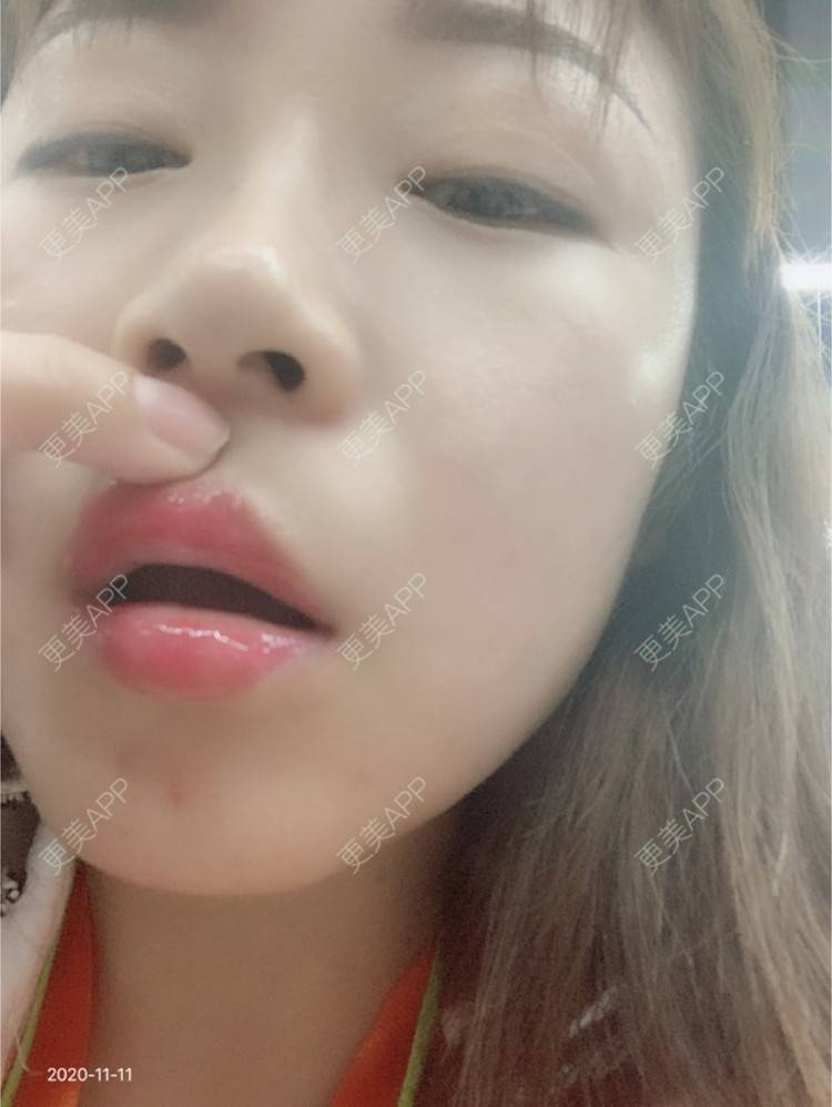 更美 - 杨会芳的半永久纹眉经验 | 上海 | 半永久纹眉 | 全飞秒激光术