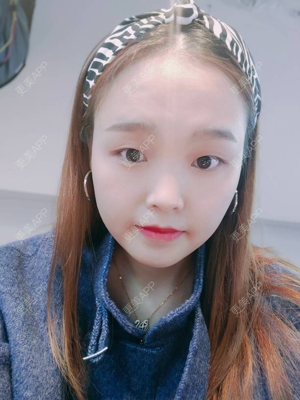 更美 - 更美用户7yneVlC6AQ的全切双眼皮经验 | 成都 | 眼部多项