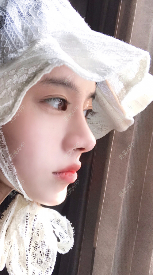 肋软骨隆鼻效果图_更美用户hkblwljrq7肋软骨隆鼻效果图_术后562天