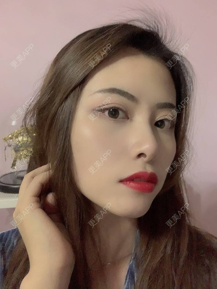 更美 - 更美用户btLT1ORxsi的全切双眼皮经验 | 广州 | 视频日记 | 全切双眼皮