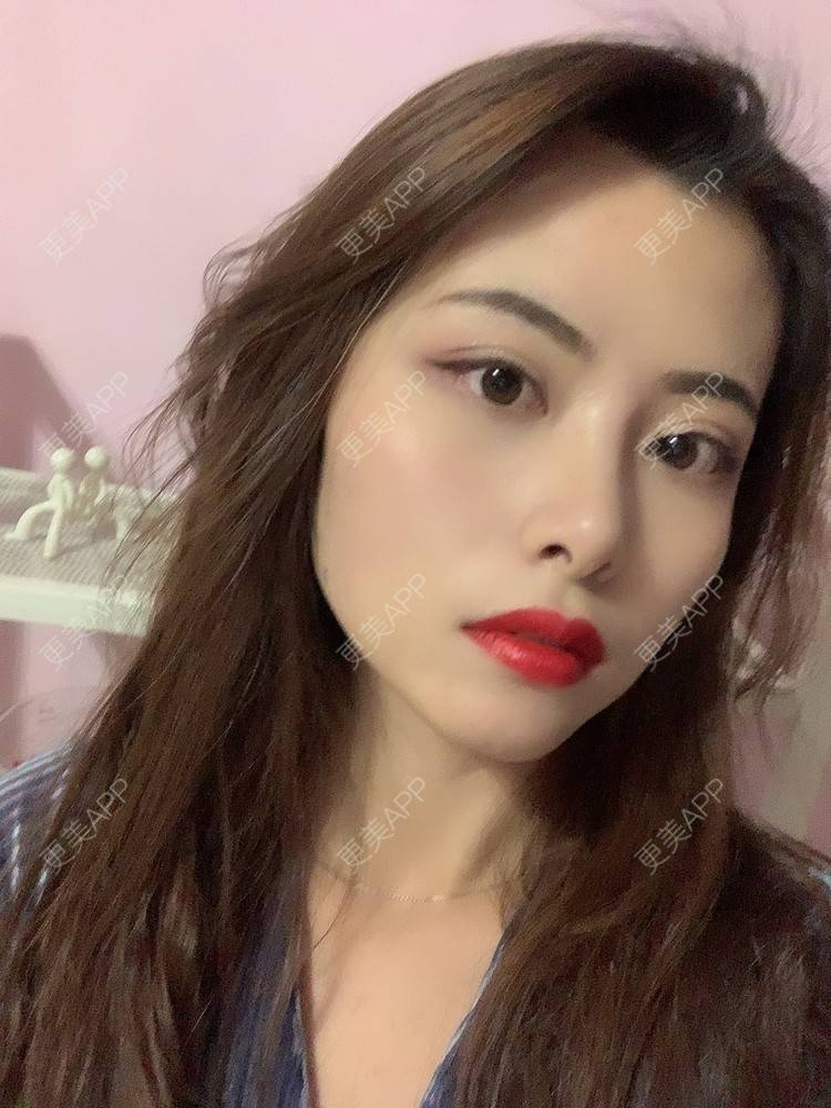 更美 - 更美用户btLT1ORxsi的全切双眼皮经验 | 广州 | 视频日记 | 全切双眼皮