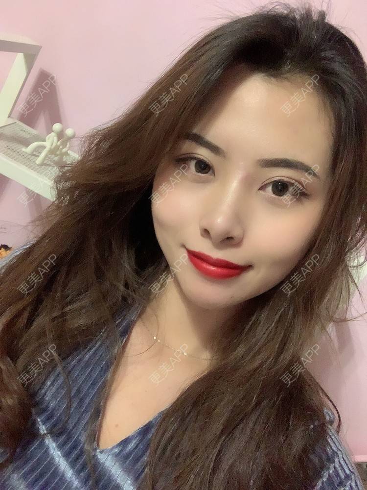 更美 - 更美用户btLT1ORxsi的全切双眼皮经验 | 广州 | 视频日记 | 全切双眼皮