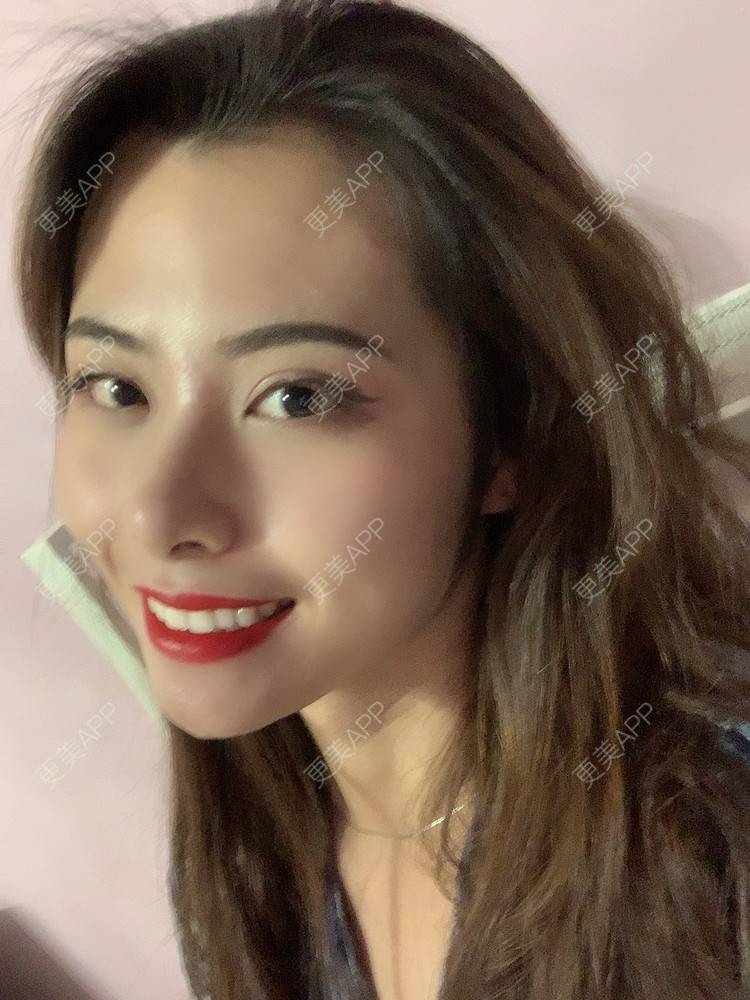 更美 - 更美用户btLT1ORxsi的全切双眼皮经验 | 广州 | 视频日记 | 全切双眼皮