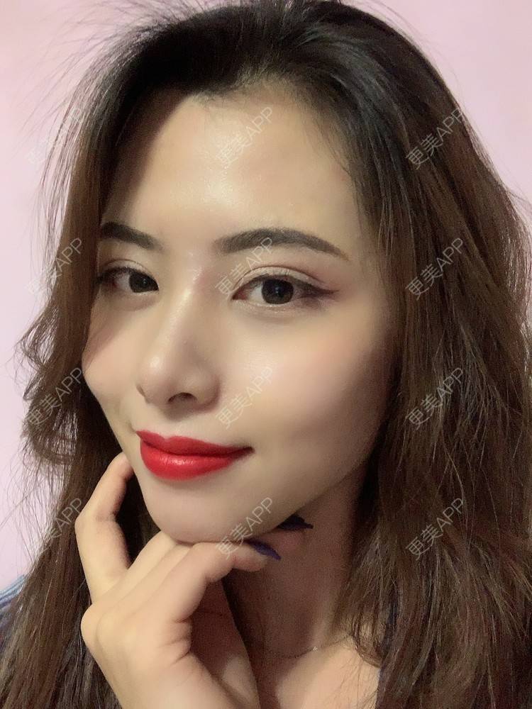 更美 - 更美用户btLT1ORxsi的全切双眼皮经验 | 广州 | 视频日记 | 全切双眼皮