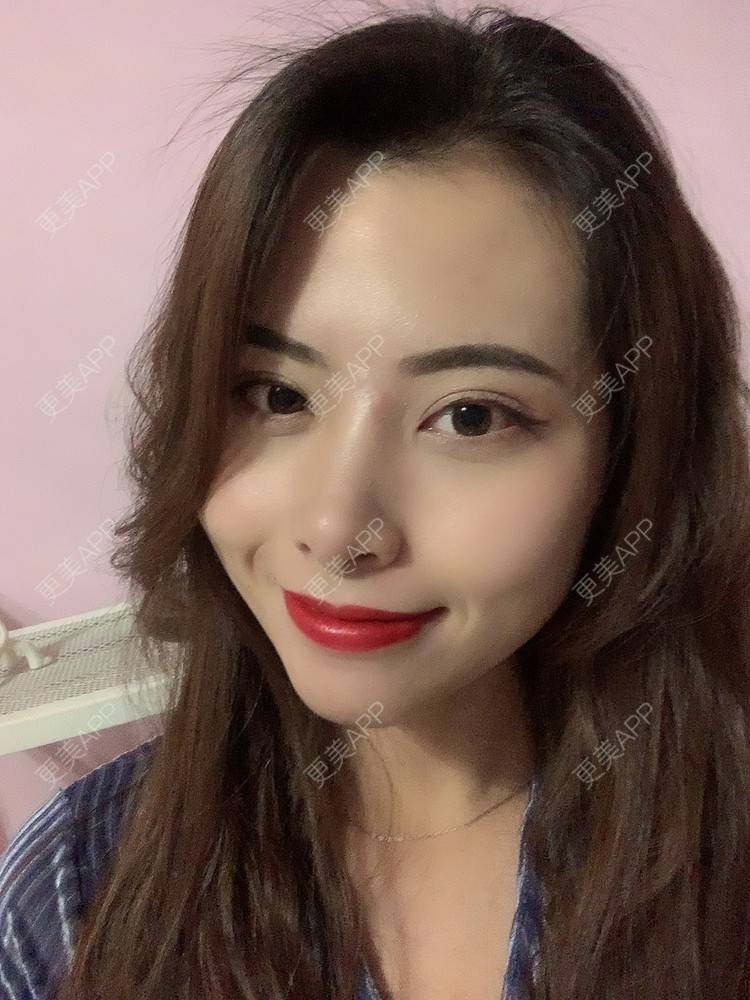 更美 - 更美用户btLT1ORxsi的全切双眼皮经验 | 广州 | 视频日记 | 全切双眼皮