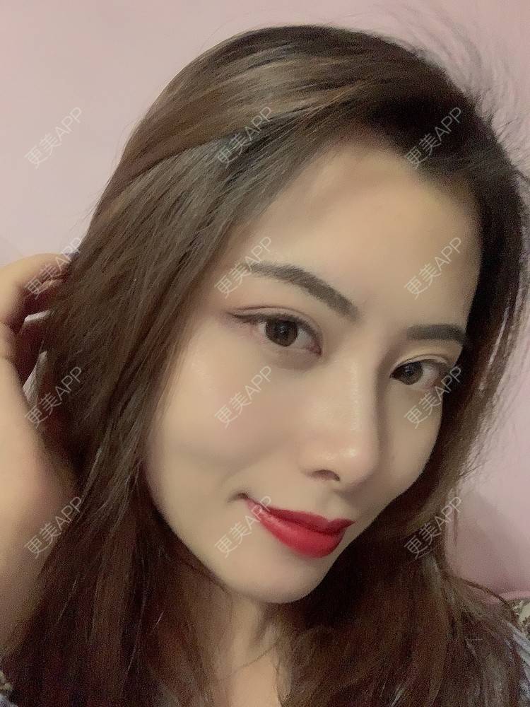 更美 - 更美用户btLT1ORxsi的全切双眼皮经验 | 广州 | 视频日记 | 全切双眼皮