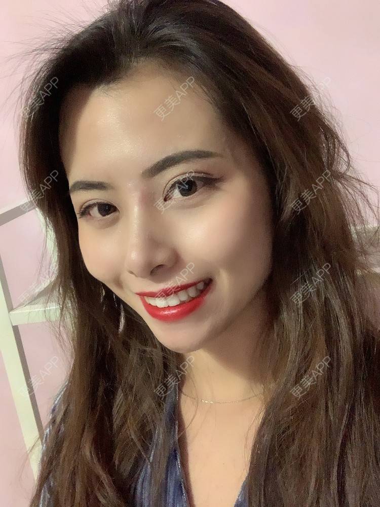 更美 - 更美用户btLT1ORxsi的全切双眼皮经验 | 广州 | 视频日记 | 全切双眼皮