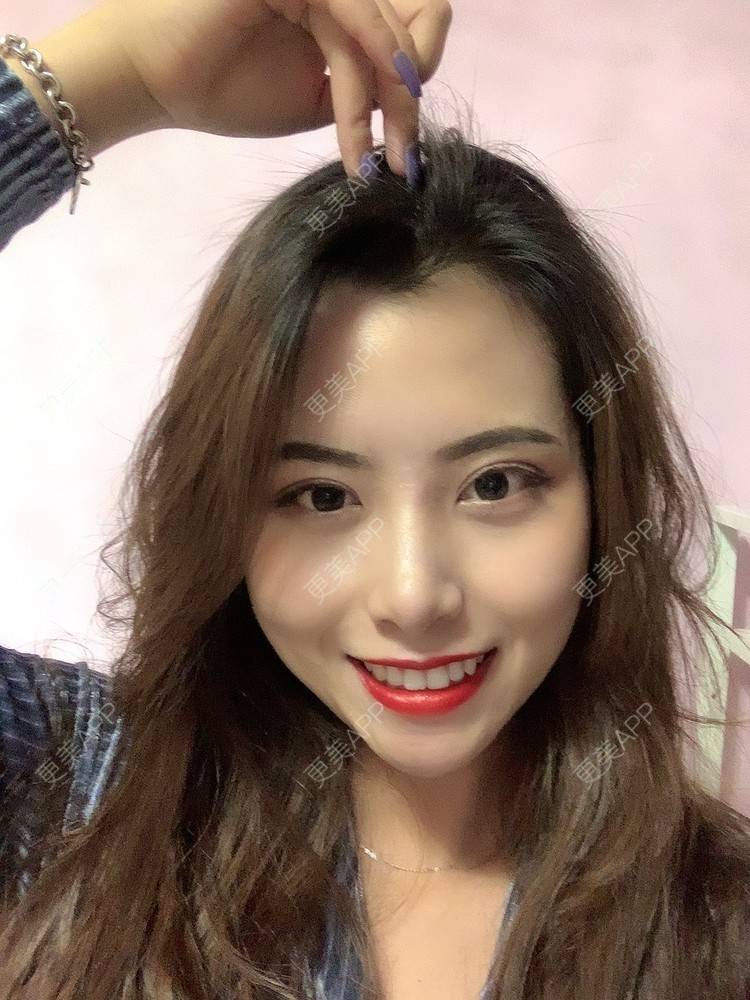 更美 - 更美用户btLT1ORxsi的全切双眼皮经验 | 广州 | 视频日记 | 全切双眼皮