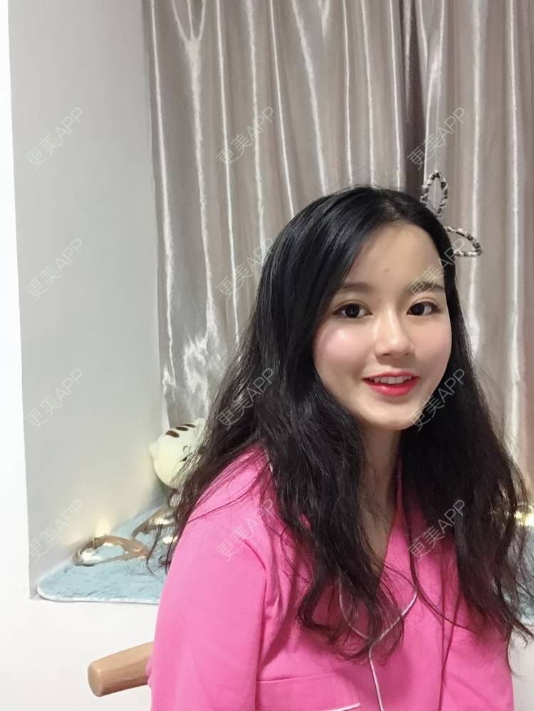 更美 - 咕噜咕噜鱼。的自体脂肪丰卧蚕经验 | 自体脂肪丰卧蚕