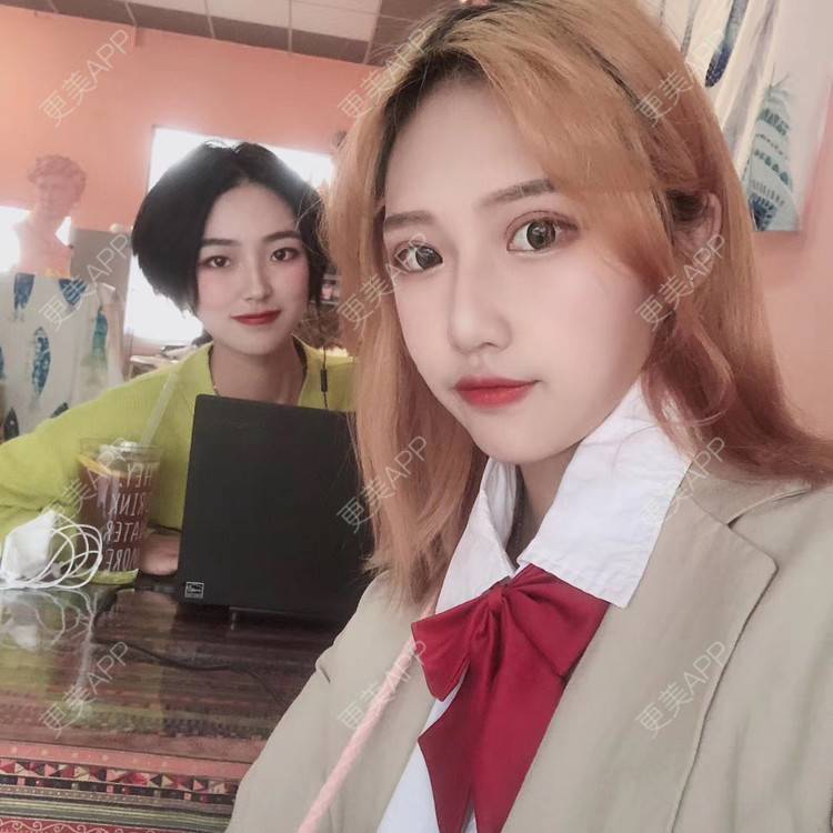 更美 - 萤萤如画的颧骨内推经验 | 广州 | 颧骨内推 | 视频日记