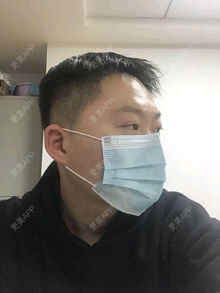 更美 - 更美用户d78qW2U8kr的鬓角植发经验 | 植发际线 | 毛发移植 | 头顶加密种植 | 鬓角植发 | 武汉 | 美人尖植发
