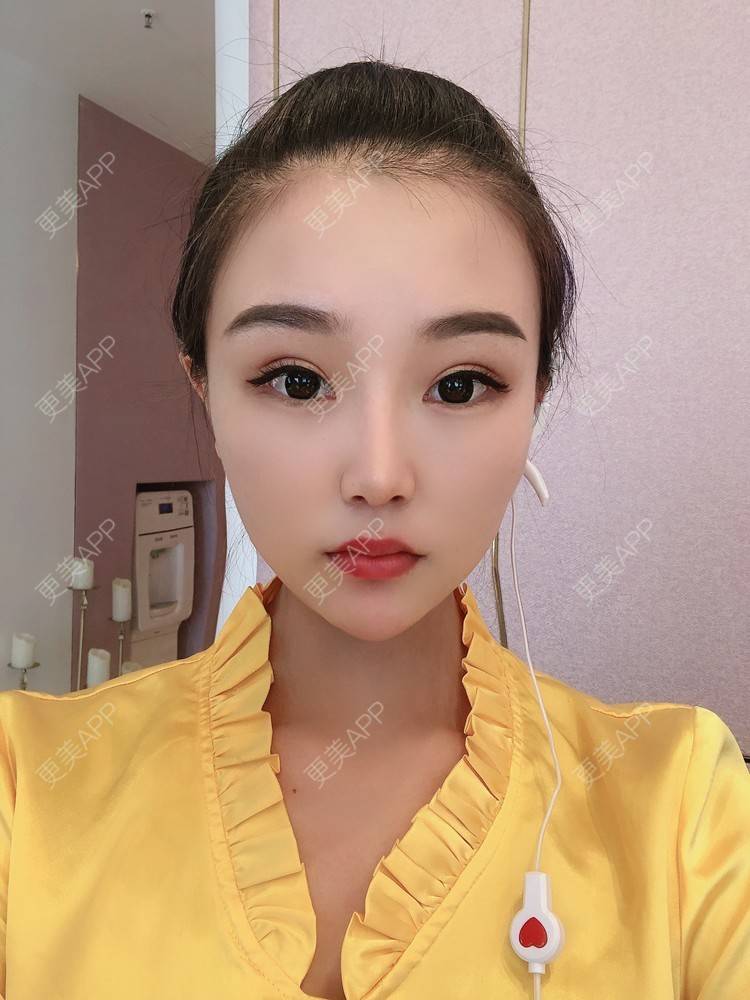 更美 - 更美用户wOARiRO1Ls的真皮丰卧蚕经验 | 北京 | 真皮丰卧蚕
