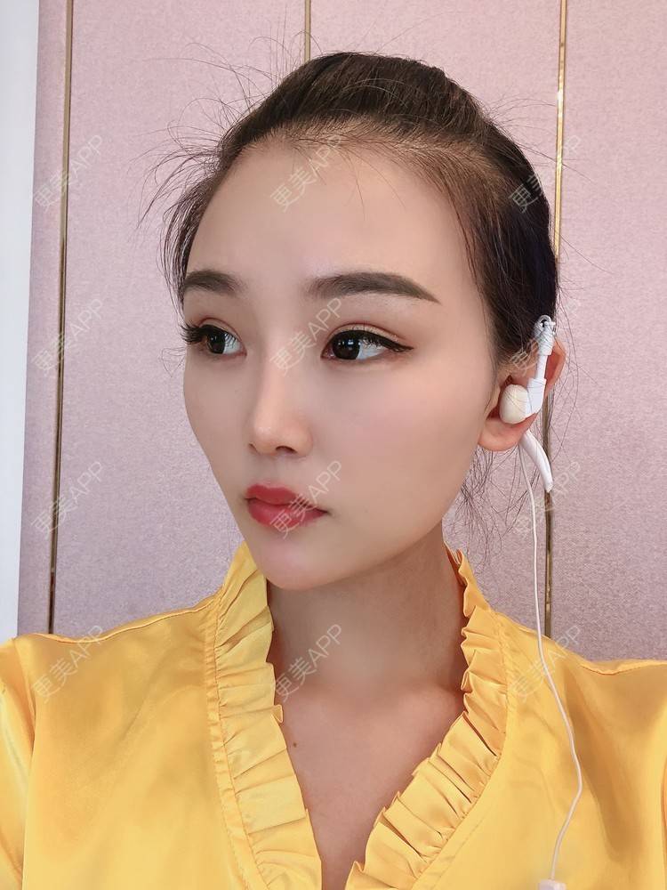 更美 - 更美用户wOARiRO1Ls的真皮丰卧蚕经验 | 北京 | 真皮丰卧蚕